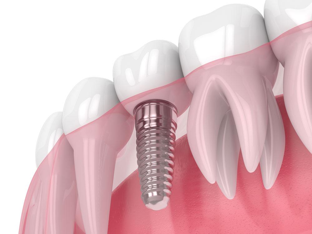 image of a titanium dental implant placement