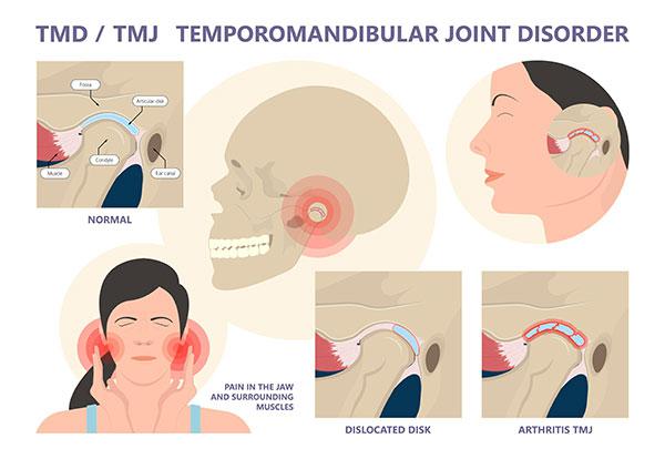 signes and symptoms of TMJ / TMD disorder